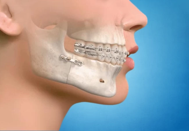 Maxillofacial Surgery